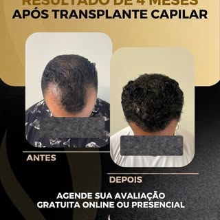 ✨Esse é o resultado de apenas 4 meses após o transplante capilar e a evolução já é incrível! 

🌱 Ma