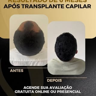 ✨Apenas 6 meses após o transplante capilar de alta densidade e o resultado já impressiona. 

Mais vo