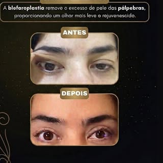 ✨ Olhar renovado, autoestima lá em cima!

A blefaroplastia é um procedimento que ajuda a reduzir o e