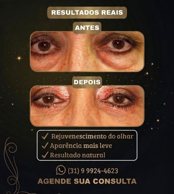 ✨ Um olhar renovado pode fazer toda a diferença!

A blefaroplastia elimina o excesso de pele e as bo