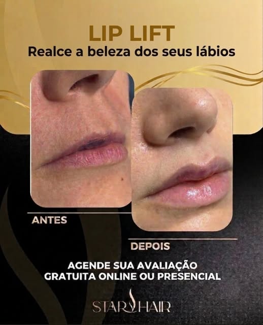 ✨ Mais definição, equilíbrio e harmonia para os seus lábios!

O Lip Lift é um procedimento que valor