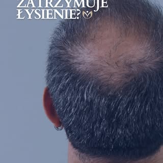 Czy przeszczep włosów zatrzymuje łysienie? 🤔

Sam przeszczep nie zatrzymuje procesu łysienia - jego