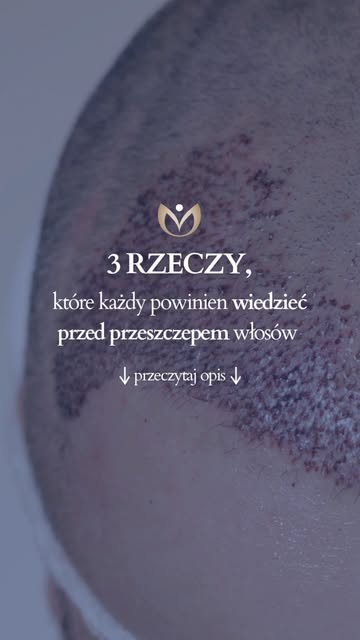 Planujesz przeszczep włosów? Zanim podejmiesz decyzję, warto wiedzieć te 3 rzeczy 👇

1️⃣ Efekt nie 