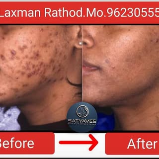 Nodular Acne👍 

Our Clinic Address :- Satyavee Clinic Mantha Chaufuli Jalna

Call For Consultation 