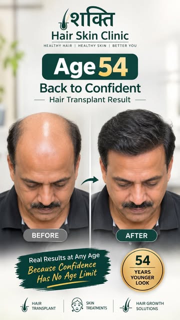 54 की उम्र… और फिर से घने बालों का आत्मविश्वास! ✨

Hair loss की कोई fixed age नहीं होती—और treatment