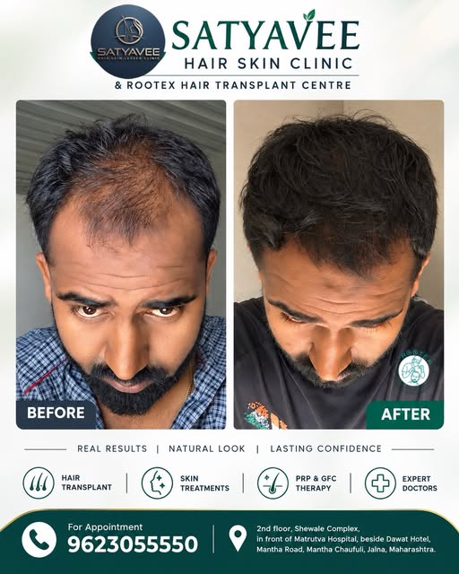 BALD TO BOLD. 💪

From visible hair loss to noticeable hair regrowth —
a transformation achieved wit