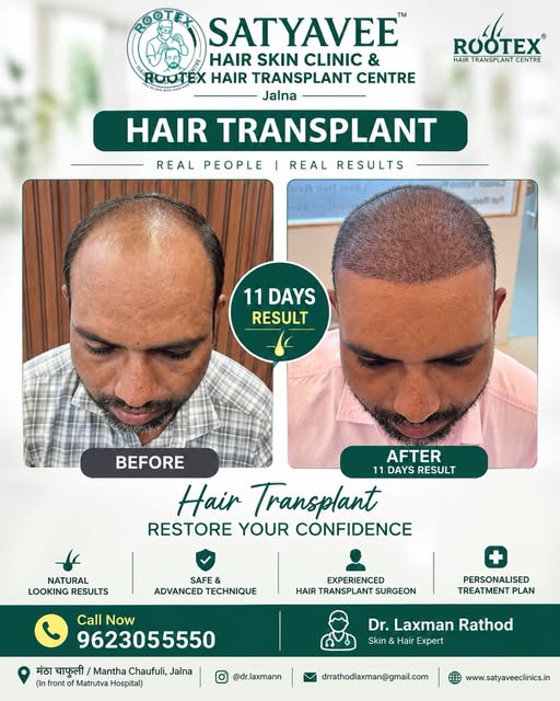 🌿 Hair Transplant – 11 Days Result | Satyavee Hair Skin Clinic
Bald to Bold — एक confident step tow