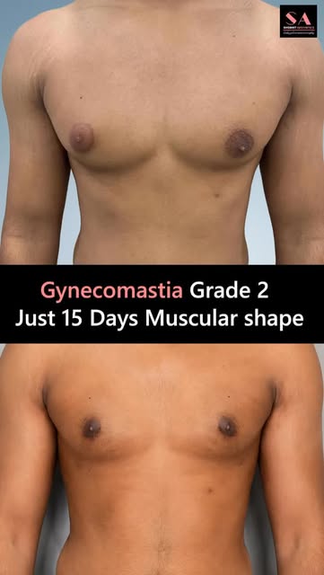 Gynecomastia Transformation — Just 15! 💪✨

A confident new chapter begins with the right treatment 