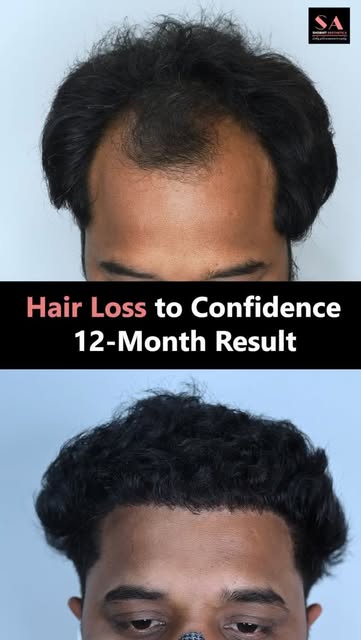 From thinning hair to a fuller, more natural-looking hairline — this 12-month Hair Transplant result