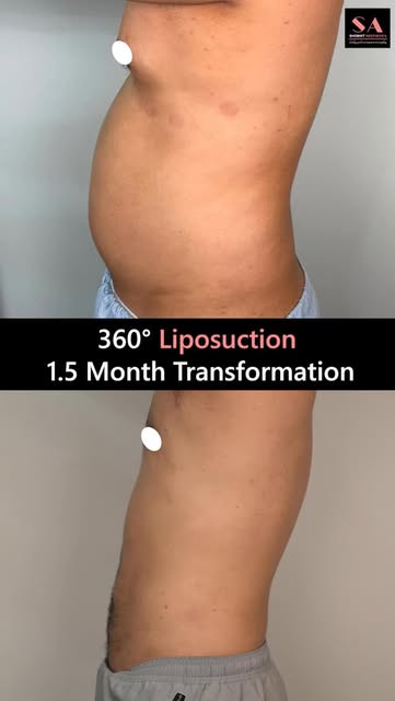 1.5-Month 360° Liposuction Transformation ✨

A visible transformation with improved body contours an