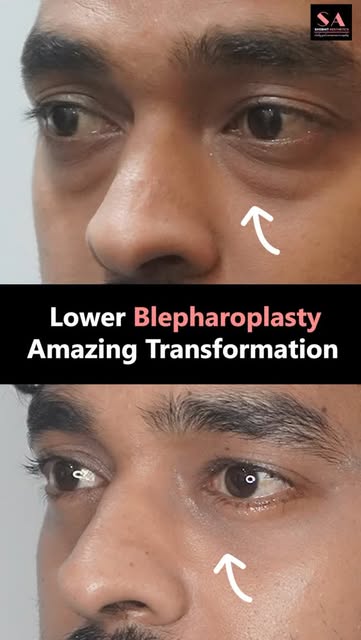 Lower Blepharoplasty Result ✨

A refreshed and more youthful-looking appearance with a subtle, natur