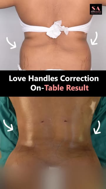 Love Handle Correction | On-Table Result ✨

A closer look at the immediate contouring result after l