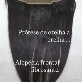 A alopecia frontal fibrosante não precisa a sua vida.

Volte a prender os cabelos, fazer penteados e