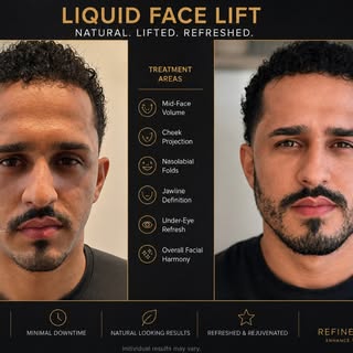 Liquid face lift #thread lift  dr Vikas Singh
