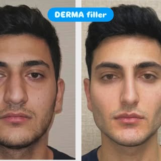 DERMA filler by dr Vikas Singh