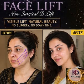 Botox, DERMA filler , thread lift , dr Vikas Singh , ko clinics