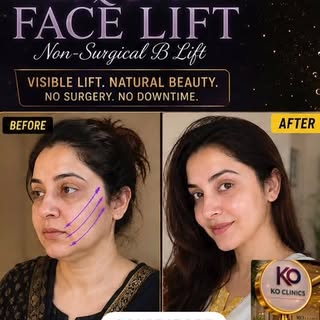 Thread lift