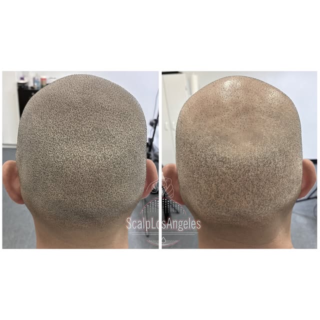 SMP/Scalp Micro Pigmentation Added To Hair Transplant For A Fuller Look And Cover Up The FUE Scar🖊️