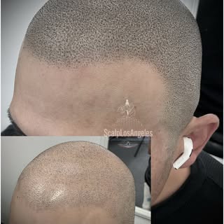 SMP/Scalp Micro Pigmentation Added To Hair Transplant For A Fuller Look And Cover Up The FUE Scar🖊️