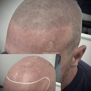 SMP/Scalp Micro Pigmentation Hairline Restoration, 2 sessions done with @5pm_shadow_pigments🔥5pm sh