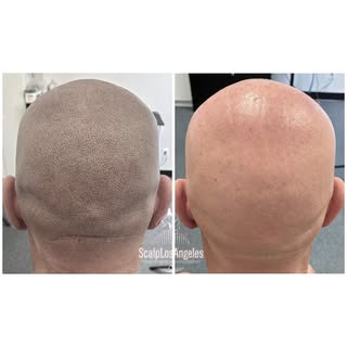 SMP/Scalp Micro Pigmentation, 2 sessions done with @5pm_shadow_pigments🔥5pm shadow machine🤩5pm sha