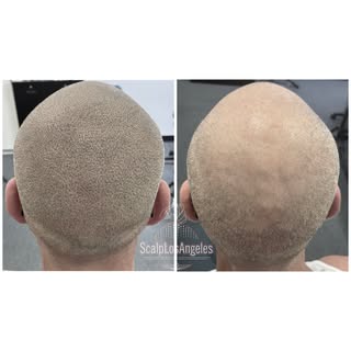 Thinning Hair On The Crown Restored!☝️2 sessions done with 5 pm shadow pigments🔥#beforeandaftersmp 