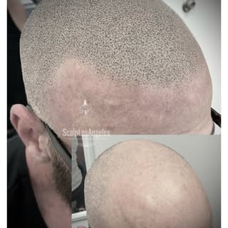 Scalp Micropigmentation Works Perfectly For “Salt and Pepper” Hair!☝️👍 2 sessions done with 5 pm sh