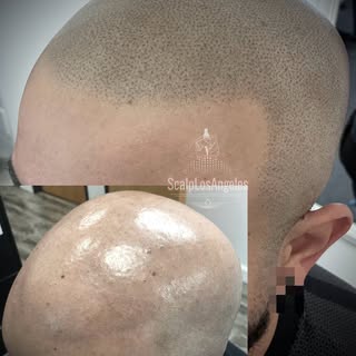 Hairline Restoration/Scalp Micropigmentation(SMP), 3 sessions done with @5pm_shadow_pigments 🔥#smp 