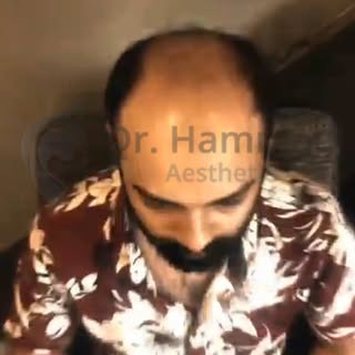 #fypシ゚viralシfypシ゚ #fuehairtransplant #DrHammadSaleemPlasticSurgeon #modeltownlahore