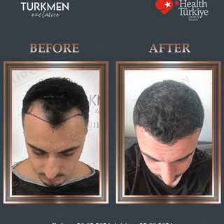 The result of our patient at only 6 months, the process continues.✨ 3500 Grafts 🙌

📌 Please contac