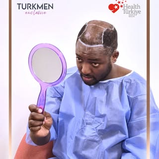 This moment marks the very beginning of the hair transplant journey. Before the procedure, the hairl