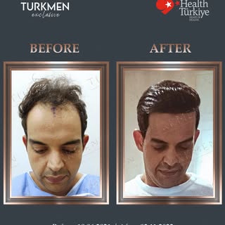 1,5 years result of our patient 🙌 With #HairTransplant, every day turns into a success story.💆🏻‍♂