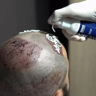 The first wash after a hair transplant is an important part of the healing process.
Foam is applied 