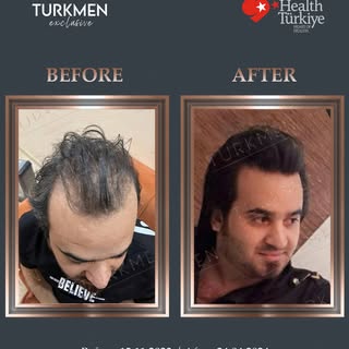 The result of our patient in only 6 months ✨ 5000 Grafts. Every day turns into a success story with 