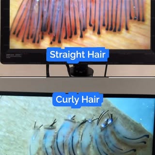 Curly vs straight hair follicles: why hair type matters in hair transplantation.
Hair texture is not
