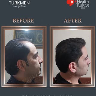 9-months result of our patient 🙌🏻 5000 grafts. Hair loss can lead to social anxiety, depression, a