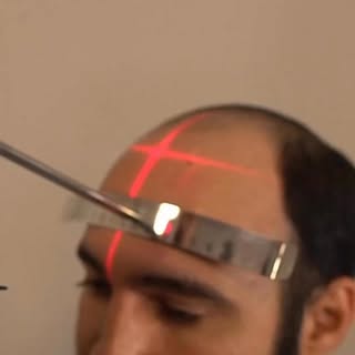 Natural results in hair transplantation are never a coincidence; it all begins with precise anatomic