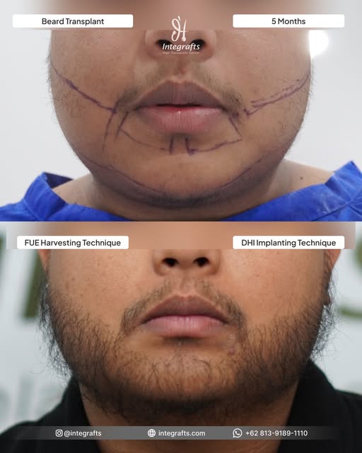Hasil nyata Beard Transplant di @integrafts — bukti nyata kalau penampilan bisa makin maskulin hanya