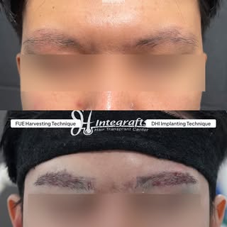 Hasil H+1 Bulan Eyebrow Transplant kak di @integrafts 🔥

Cocok buat kamu yang alisnya tipis, atau n