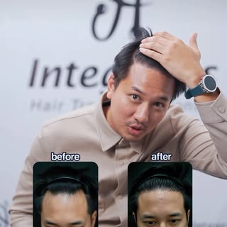 1 tahun pasca hair transplant kak @christ_ryan 
Garis M-shape hilang total dan penampilan kembali ta