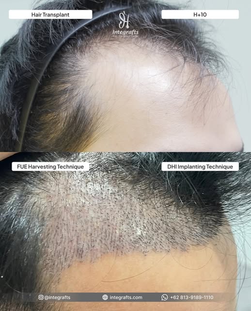 Baru 10 hari tapi baby hair sudah mulai tumbuh??😱😳

✅ Tanpa harus konsultasi offline
✅ Dengan tekn
