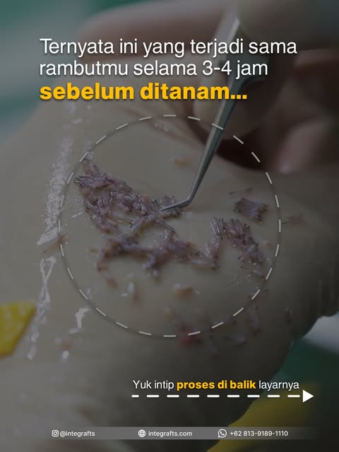 Kunci tanam rambut sukses ternyata bukan sekedar mindahin rambut!

Ini dia yang dialami rambut sebel