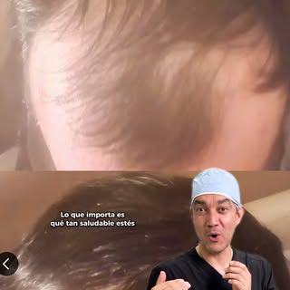 ¿Cuándo es demasiado tarde para un trasplante de cabello? 💇‍♂️🌱 El Dr. JC Álvarez explica que nunc