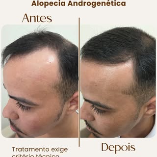 Resultado de um diagnóstico preciso. 

Na alopecia androgenética, cada detalhe importa para interrom