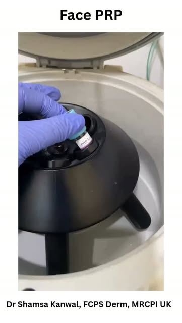 Face PRP uses a concentrated portion of your own blood platelets to support natural skin repair and 