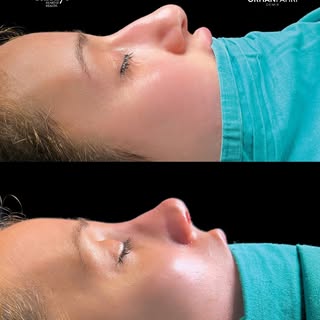 Your nose is one of the most important features of your face. ✨
With personalized rhinoplasty, we ai