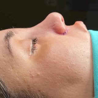 👃✨ The nose that suits your face best is the one that looks the most natural on you.

Rhinoplasty i