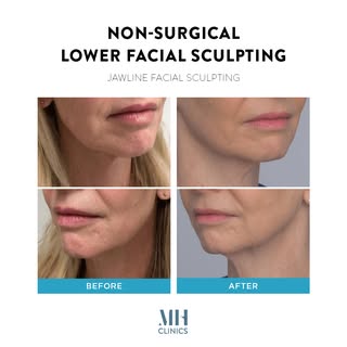 📸 Lower Facial Sculpting with AGNES Radio Frequency – Before & After

This transformation demonstra