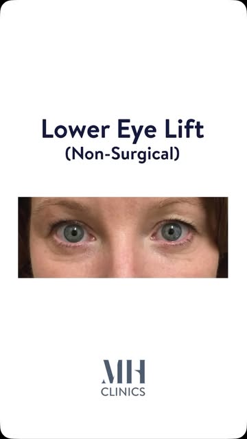 Under-eye puffiness: could a non-surgical treatment be right for you?

The answer starts with unders