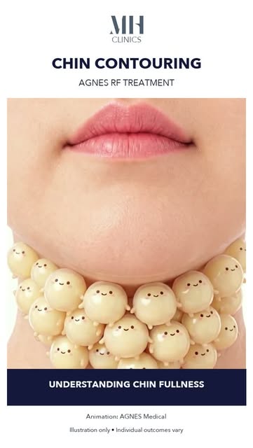 A double chin isn’t always just about fat.

Skin laxity and individual anatomy can also influence th
